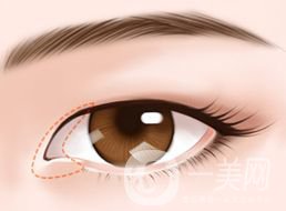 開(kāi)眼角的*果怎么樣 好不好？