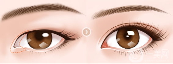開(kāi)眼角的*果怎么樣 好不好？