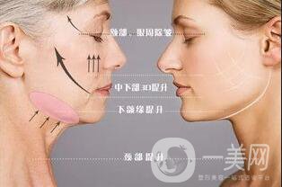 面部提升手術(shù)費(fèi)用