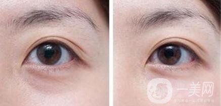 淚溝填充消腫時(shí)間