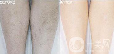 北京光子脫毛價(jià)格