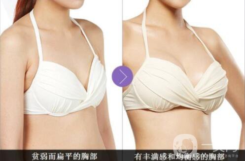 自體脂肪隆胸多久不疼？ 脂肪隆胸的害處？