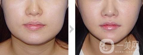 面部吸脂多久能看到*果 注意事項(xiàng)是什么