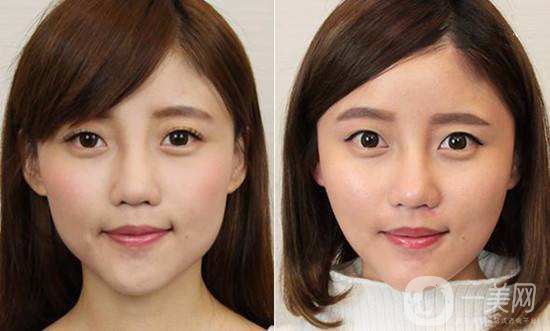 什么是方下巴手術(shù) *手術(shù)的特點