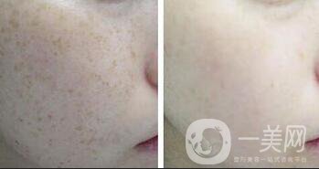 激光祛斑和光子嫩膚的區(qū)別