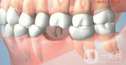 人工種植牙價格,人工種植牙壽命是多少年
