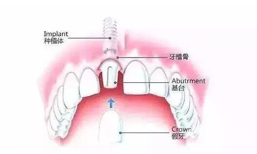 人工種植牙價格,人工種植牙壽命是多少年