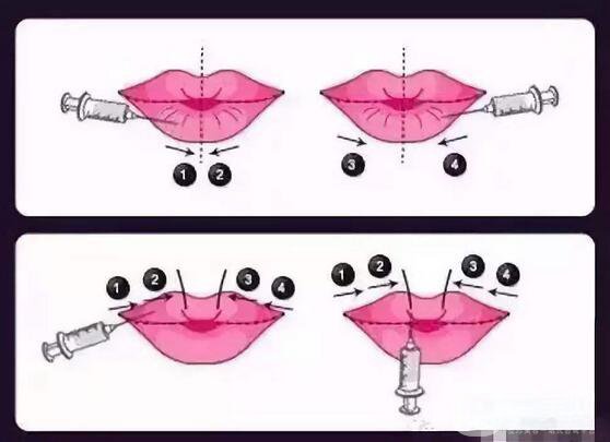 玻尿酸豐唇有什么危害呢 玻尿酸豐唇怎么樣？