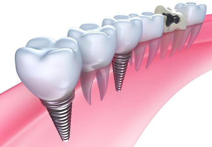 種植牙多少錢一顆 價(jià)格高不高？