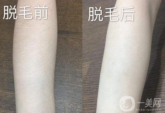 激光脫毛詳細(xì)介紹 激光脫毛有哪些優(yōu)缺點？