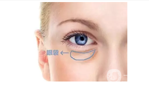 去眼袋手術(shù)費用是多少錢 *果*嗎