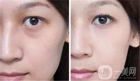 去眼袋手術(shù)費用是多少錢 *果*嗎