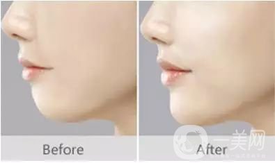 自體脂肪填下巴*果如何? 價(jià)格是多少呢？