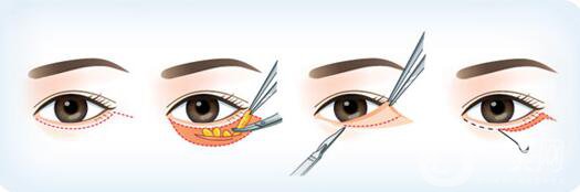 韓式去眼袋怎么樣？多久*果