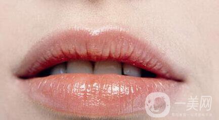 玻尿酸豐唇多久消腫,玻尿酸豐唇注意事項(xiàng)