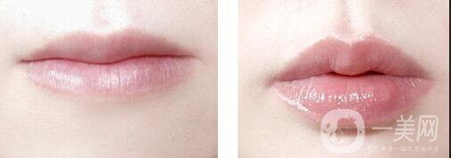 玻尿酸豐唇多久消腫,玻尿酸豐唇注意事項(xiàng)
