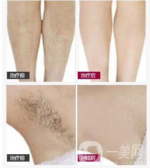 影響腋下脫毛價(jià)格的因素有哪些