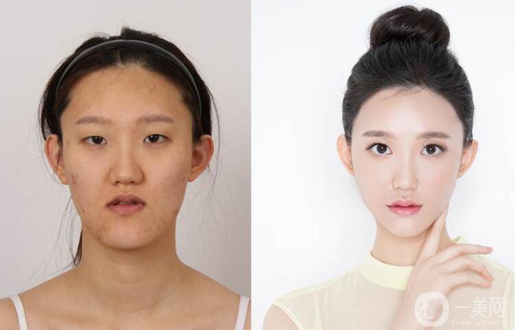 什么是納米雙頜截骨術 納米雙頜截骨術的特點