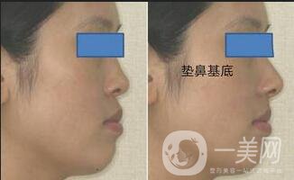 墊鼻基底材料,墊鼻基底術(shù)后護(hù)理