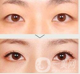 哪些人不適合做雙眼皮,雙眼皮價格,雙眼皮術(shù)后護(hù)理