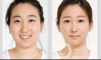 臉部抽脂*果,臉部抽脂多少錢