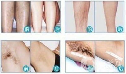 激光脫毛需要做幾次？*果真的*嗎？