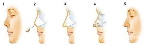 自體肋軟骨隆鼻后遺癥有些啥？