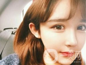 割雙眼皮多久恢復(fù)自然？