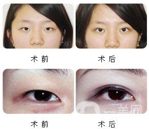 割雙眼皮多久恢復(fù)自然？