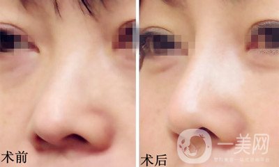 膨體隆鼻是終生的嗎？