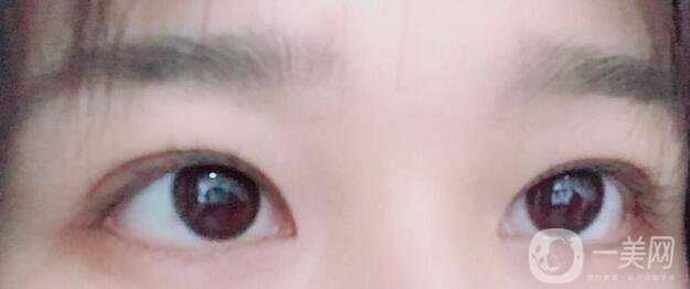 埋線雙眼皮維持幾年,納米*雙眼皮