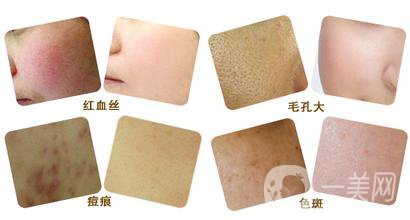 彩光嫩膚好嗎？*果如何？