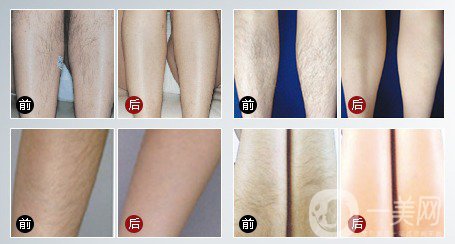 激光脫毛脫了還會(huì)長(zhǎng)嗎？