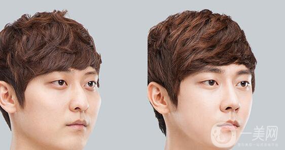 高級面部輪廓手術(shù)有哪些？