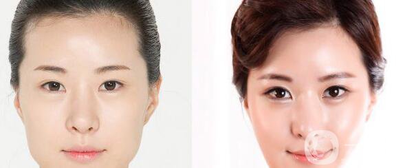 高級面部輪廓手術(shù)有哪些？