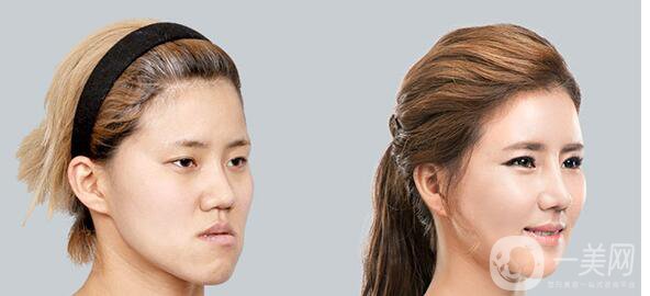 高級面部輪廓手術(shù)有哪些？