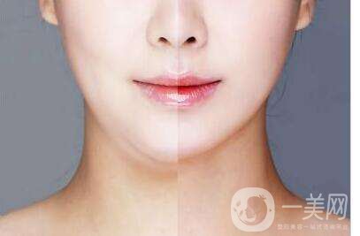 臉部吸脂術(shù)大概多少錢 臉部吸脂會(huì)反彈嗎？