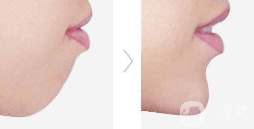 下頜骨后縮怎么矯正？矯正方法有哪些？