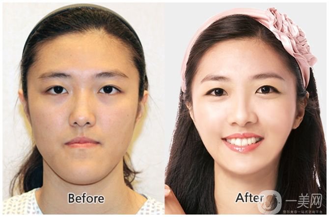 下頜后縮會不會遺傳呢 下頜后縮可以調(diào)節(jié)嗎