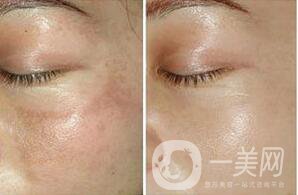 彩光嫩膚,光子嫩膚