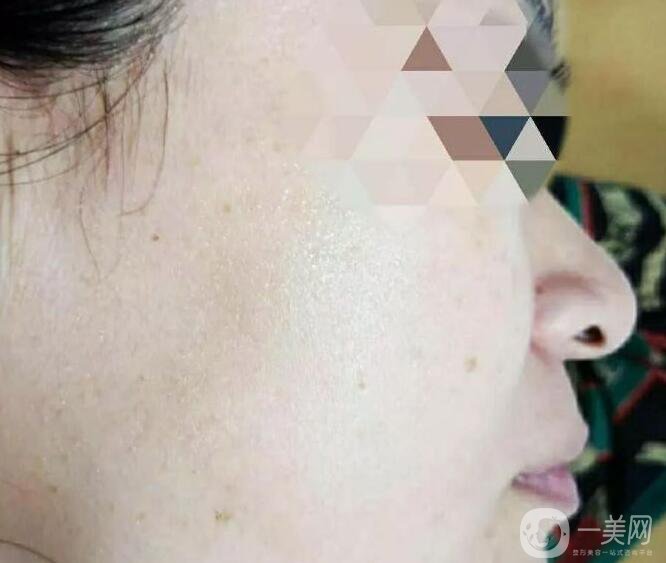 鐳射美白嫩膚*果