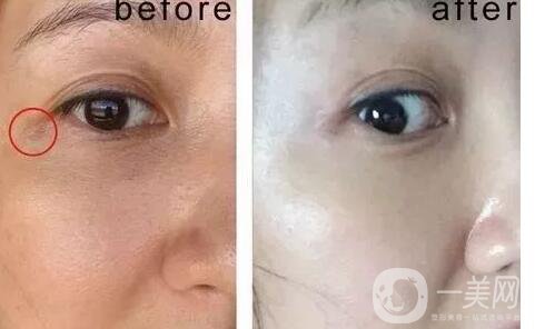 光電美容價格,光電美容副作用