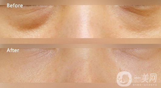 內(nèi)吸去眼袋多少錢 去眼袋方式有哪些？