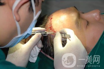 植發(fā)費用多少錢 價格高不高？