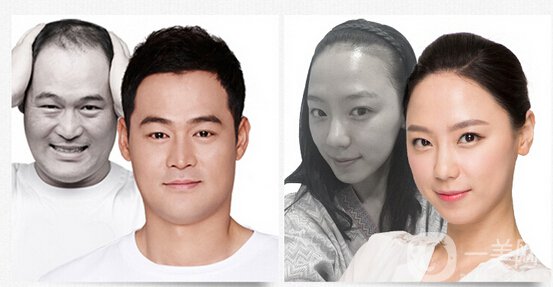 植發(fā)費用一般是多少？植發(fā)前后