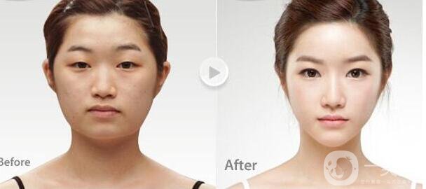 *手術(shù)后幾天恢復(fù) 手術(shù)恢復(fù)過(guò)程