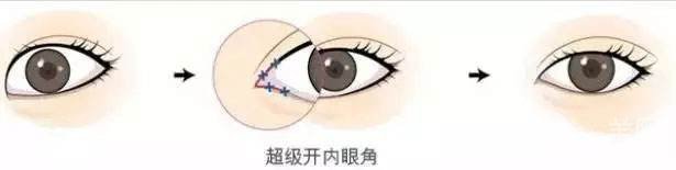 *開眼角怎么做的 *開眼角多久恢復(fù)