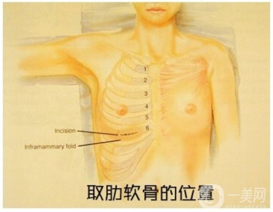 自體肋軟骨隆鼻危害有哪些？隆鼻價格