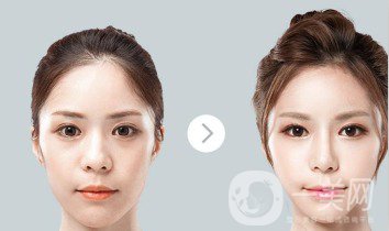 自體肋軟骨隆鼻危害有哪些？隆鼻價格