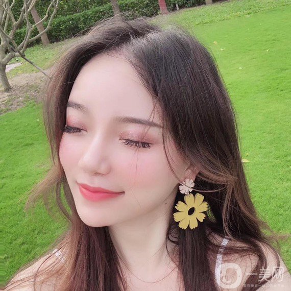 植發(fā)半年后案例 植發(fā)怎么樣？